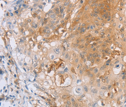 Иммуногистохимия, CD85d, ткань рака шейки матки человека
