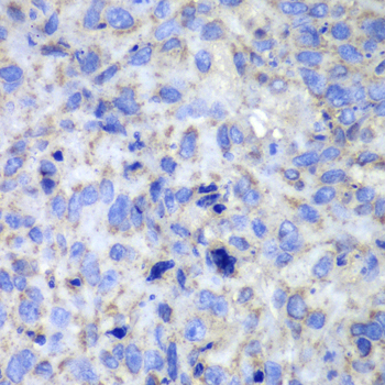 Иммуногистохимия, Caspase-7, ткань рака легкого человека