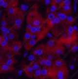 Иммунофлуоресценция, Ubiquitin, ткань рака желудка человека