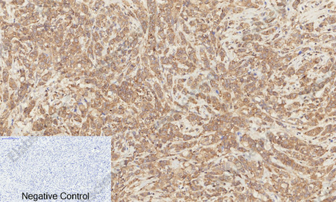 Иммуногистохимия, Phospho-Catenin beta (Ser37), ткань рака молочной железы человека