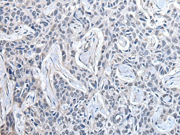 Иммуногистохимия, PPIG, ткань рака легкого человека