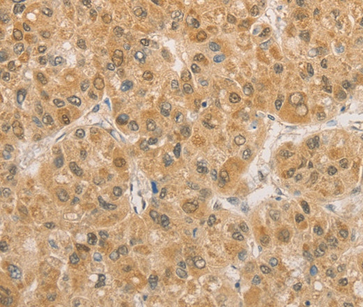 Иммуногистохимия, PGK2, ткань рака печени человека