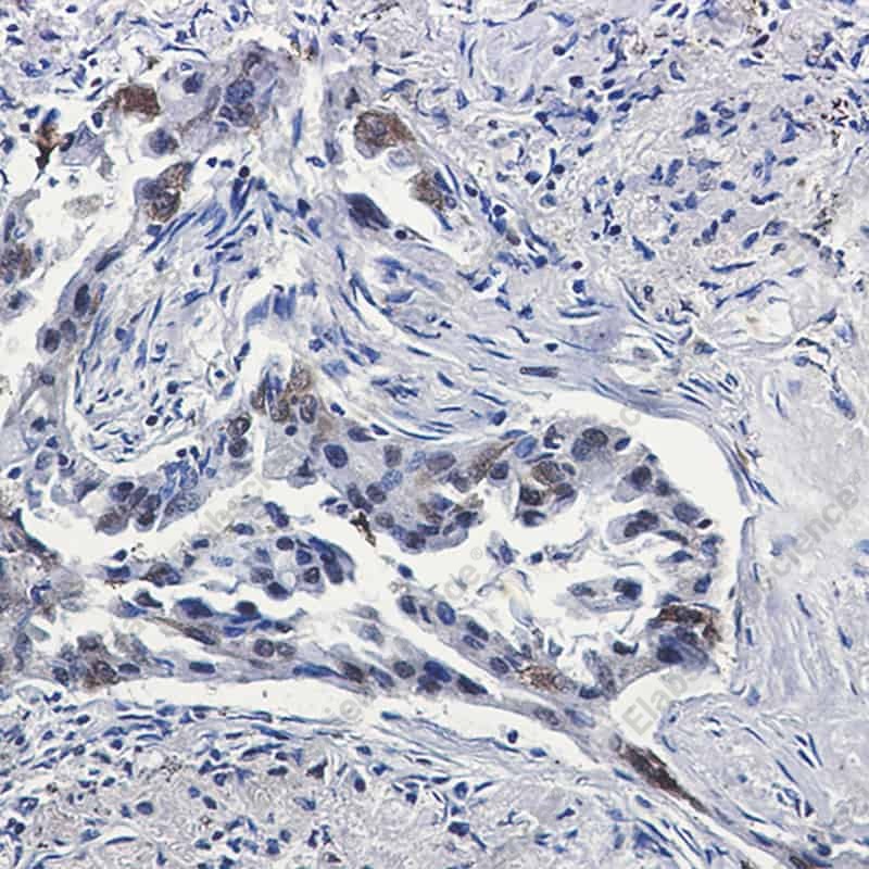 Иммуногистохимия, Tissue Factor, ткань рака легкого человека