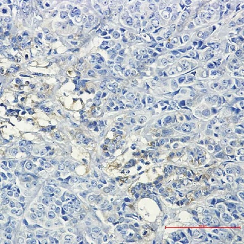 Иммуногистохимия, Hexokinase II, ткань рака молочной железы человека