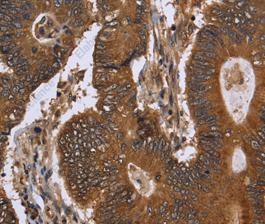 Иммуногистохимия, FGFRL1, ткань колоректального рака человека
