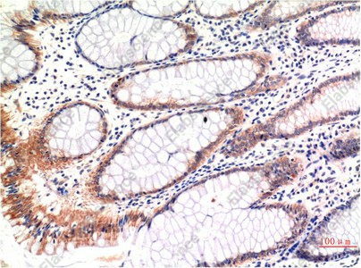 Иммуногистохимия, Phospho-MLKL (Ser358), ткань карциномы толстой кишки человека