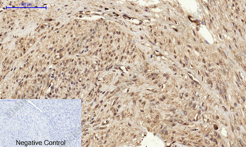 Иммуногистохимия, BRCA1, ткань рака матки человека