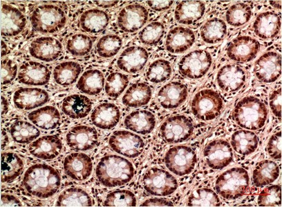 Иммуногистохимия, gamma Tubulin, ткань карциномы толстой кишки человека