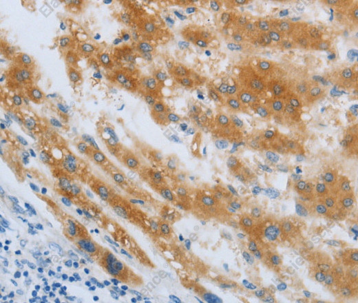 Иммуногистохимия, CHRNA7, ткань рака печени человека