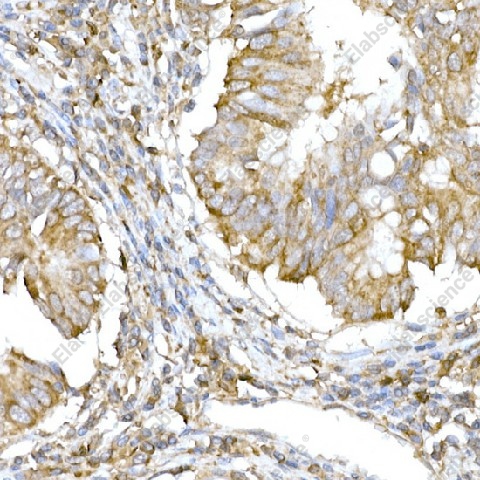Иммуногистохимия, IRE1, ткань карциномы толстой кишки человека