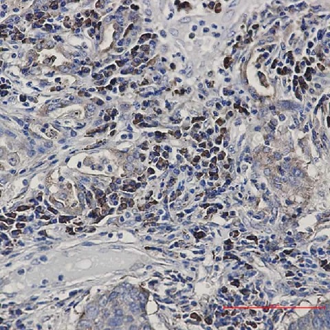 Иммуногистохимия, Alkaline Phosphatase Tissue Non-Specific, ткань рака легкого человека