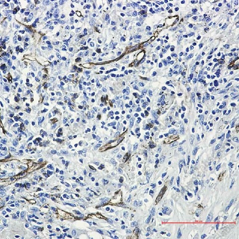 Иммуногистохимия, CD31, ткань рака легкого человека