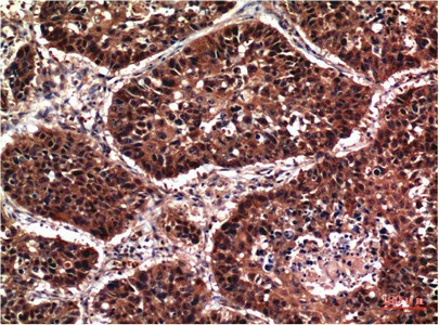 Иммуногистохимия, Phospho-AKT1 (Ser473), ткань карциномы легкого человека