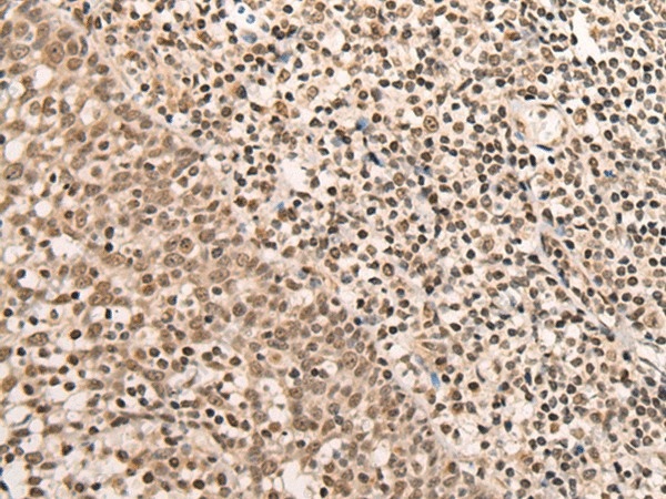 Иммуногистохимия, ARID1B, ткань миндалин человека