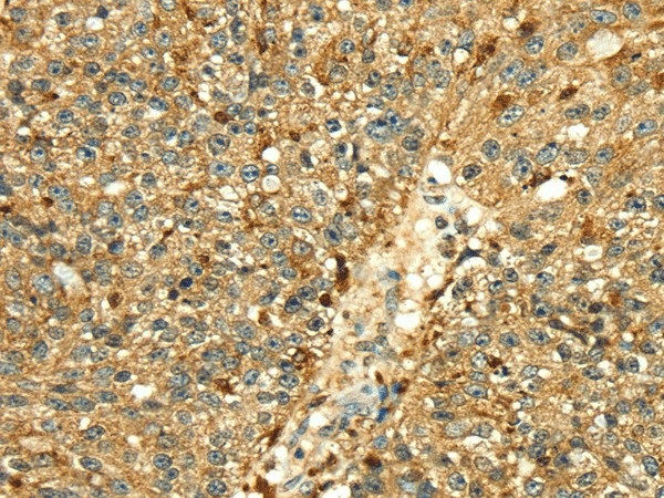 Иммуногистохимия, Cathepsin H, ткань рака молочной железы человека