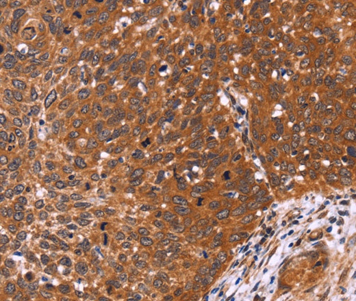 Иммуногистохимия, CDC37L1, ткань рака шейки матки человека