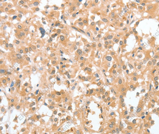 Иммуногистохимия, CIAPIN1, ткань рака щитовидной железы человека