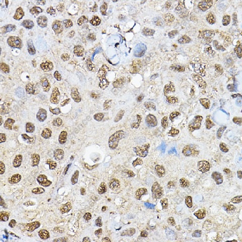 Иммуногистохимия, p70 S6 Kinase 1, ткань рака молочной железы человека