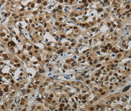 Иммуногистохимия, DNA Ligase1, ткань рака пищевода человека