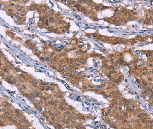 Иммуногистохимия, Histamine H3 Receptor, ткань рака желудка человека