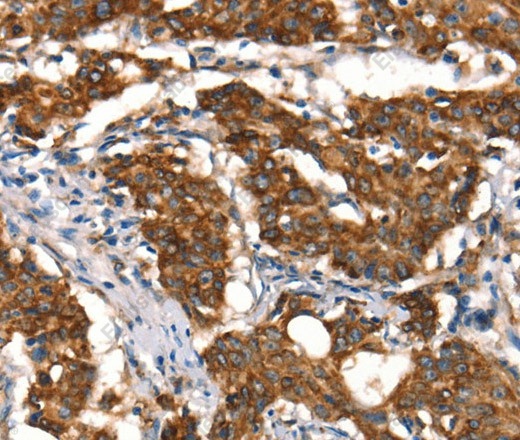 Иммуногистохимия, Cytochrome b, ткань рака желудка человека