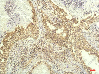 Иммуногистохимия, p70 S6 kinase alpha, ткань карциномы легкого человека