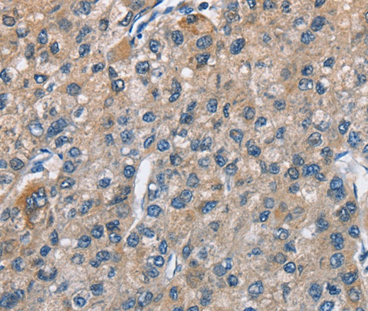 Иммуногистохимия, TRIP4, ткань рака печени человека