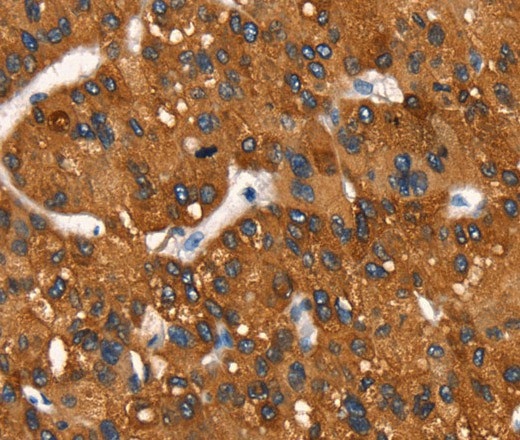 Иммуногистохимия, Cytochrome b, ткань рака печени человека