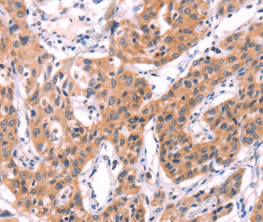 Иммуногистохимия, SERPINA5, ткань рака легкого человека