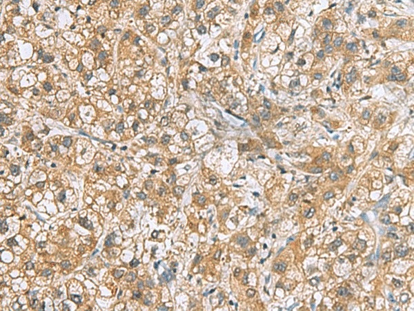 Иммуногистохимия, DNPH1, ткань рака печени человека