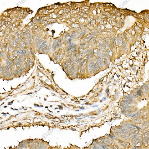Иммуногистохимия, Hsp90β, ткань карциномы толстой кишки человека