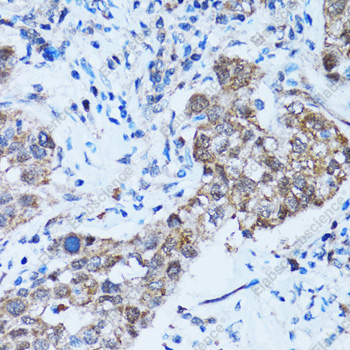 Иммуногистохимия, Caspase-3, ткань рака легкого человека