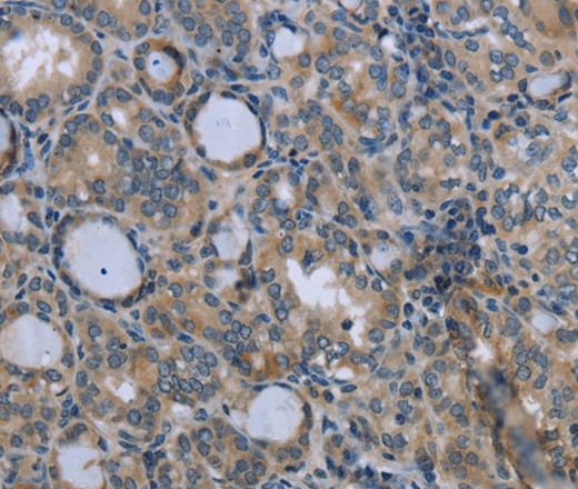 Иммуногистохимия, EGFL8, ткань рака щитовидной железы человека