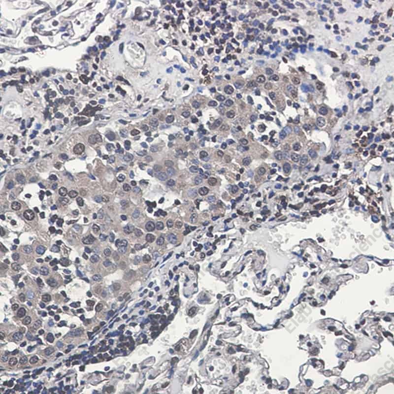 Иммуногистохимия, Rsk 2/MAPKAP Kinase 1b, ткань рака легкого человека