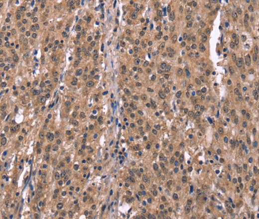 Иммуногистохимия, Histamine H1 Receptor, ткань рака желудка человека