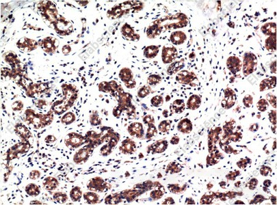 Иммуногистохимия, Phospho-ERK 1/2 (Tyr222/205), ткань карциномы молочной железы человека
