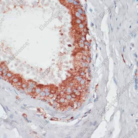 Иммуногистохимия, PGK2, ткань рака молочной железы человека