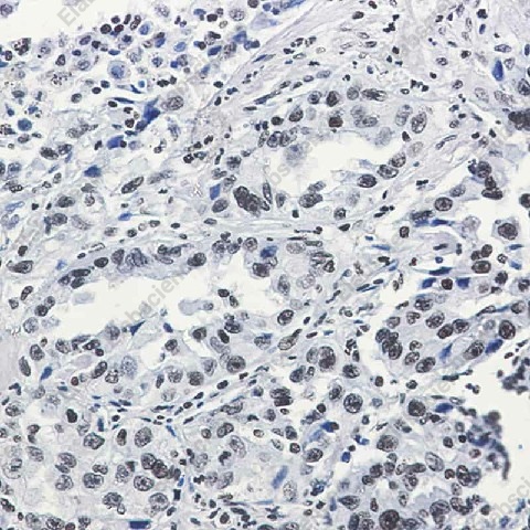 Иммуногистохимия, Histone H3 (acetyl-Lys27), ткань рака легкого человека