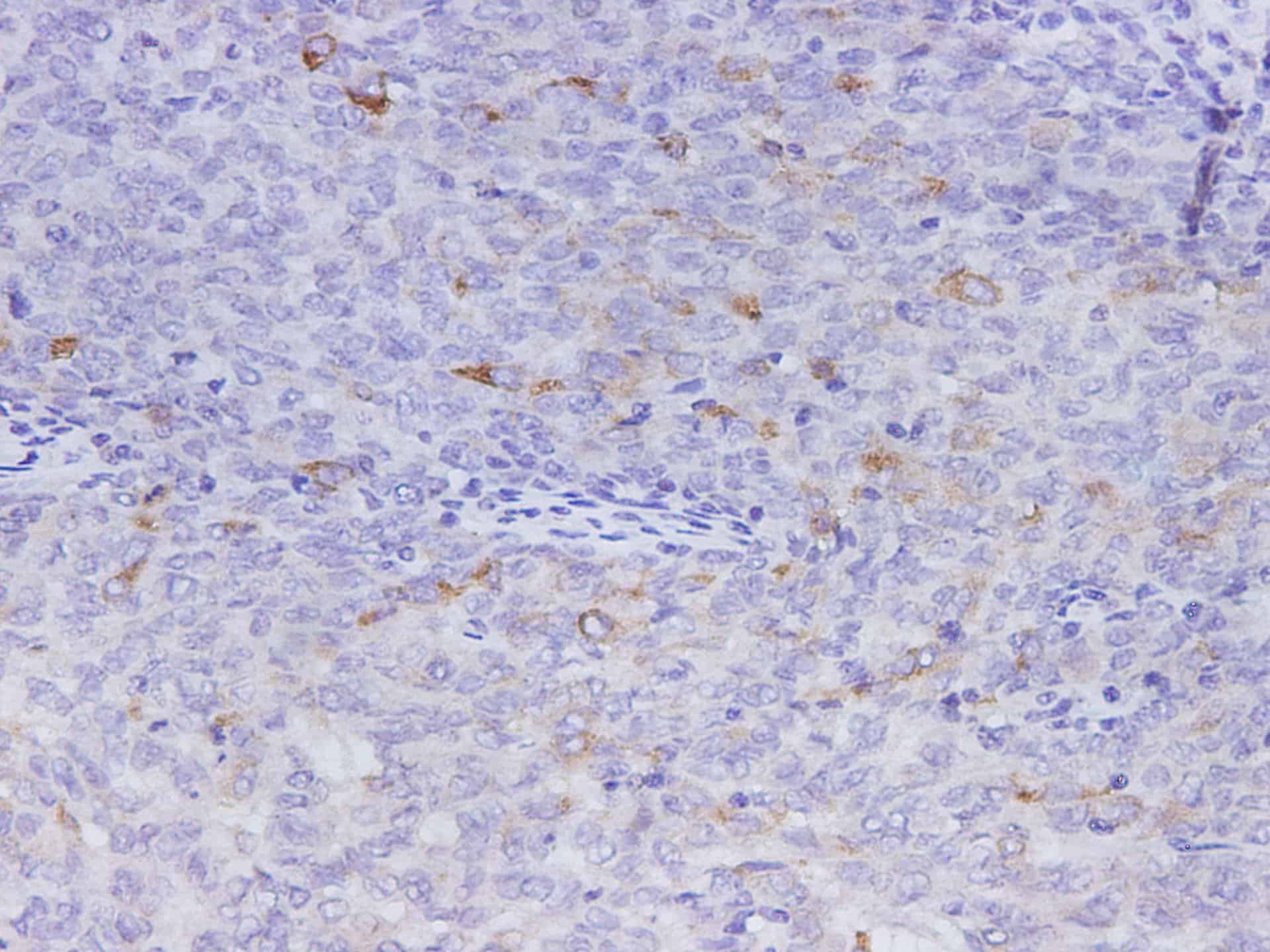 Иммуногистохимия, MMP-1, ткань рака шейки матки человека