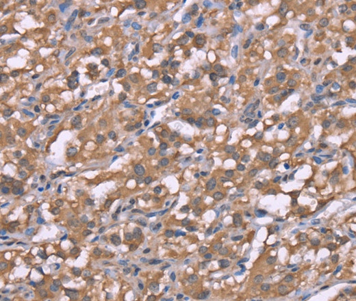 Иммуногистохимия, Histamine H3 Receptor, ткань рака щитовидной железы человека