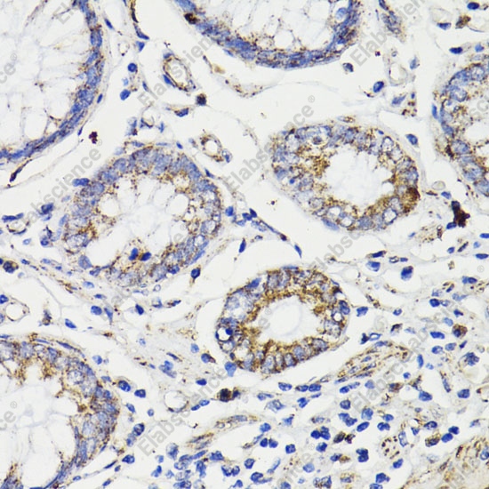 Иммуногистохимия, Caspase-8, ткань карциномы толстой кишки человека