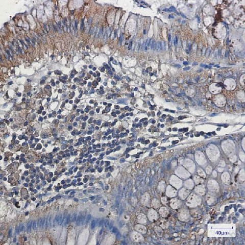 Иммуногистохимия, VEGF Receptor 1, ткань рака толстой кишки человека