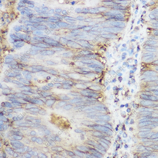 Иммуногистохимия, beta 2 Microglobulin, ткань карциномы толстой кишки человека