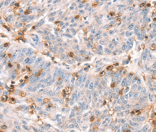 Иммуногистохимия, CD43, ткань рака яичника человека