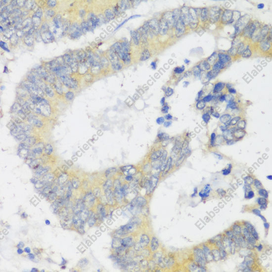 Иммуногистохимия, Snail, ткань карциномы толстой кишки человека