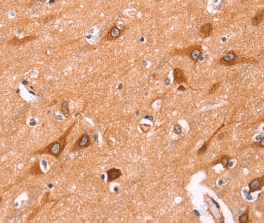 Иммуногистохимия, NCEH1, ткань рака щитовидной железы человека
