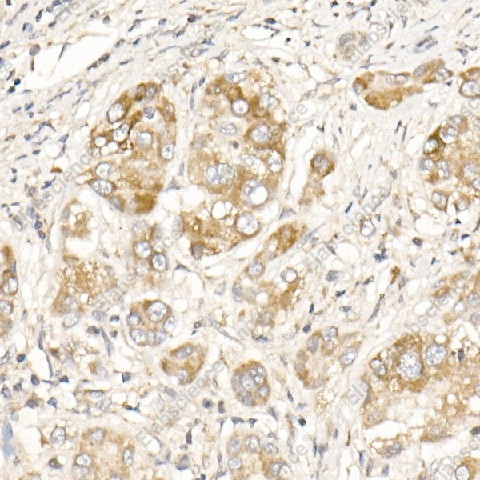 Иммуногистохимия, PGAM5, ткань рака печени человека