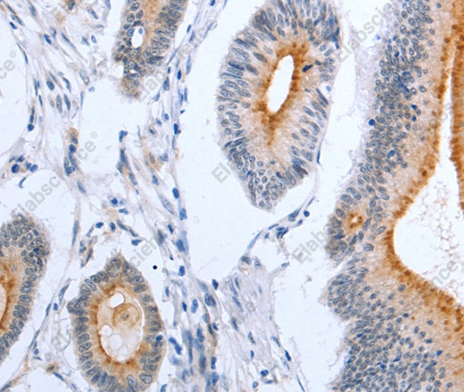 Иммуногистохимия, PLAUR, ткань колоректального рака человека