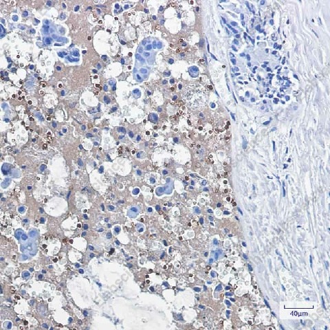 Иммуногистохимия, Catalase, ткань рака молочной железы человека
