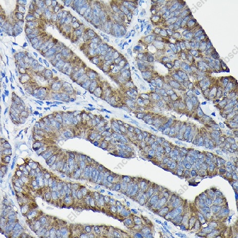 Иммуногистохимия, Nesprin 1, ткань карциномы толстой кишки человека